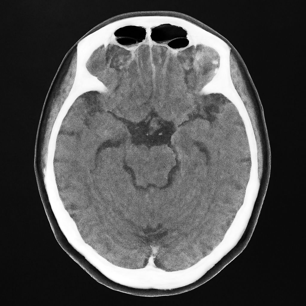 CTA Liberty, Neck, Brain, Program, and Bilateral: Understanding CT Angiography